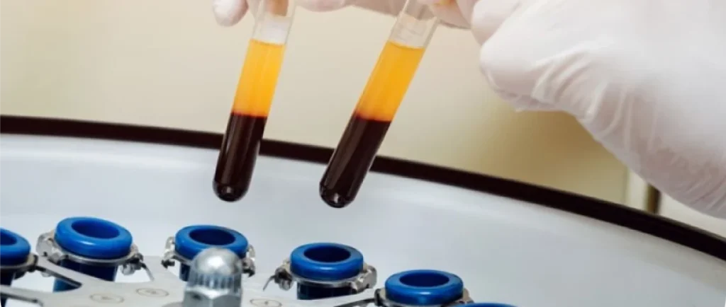 PRF : Plaquettes Riches en Fibrine